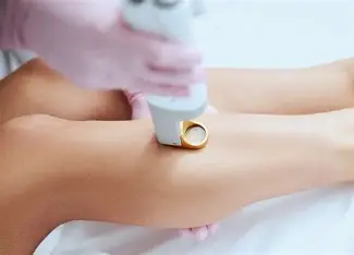 Laser hair removal